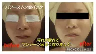 フェイシャルパワーストン泡エステ✨