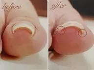 💎巻き爪矯正💎両足✨️