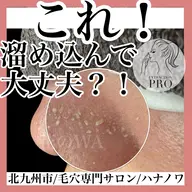 ★エリア希少★【毛穴エクストラクションプロコース】