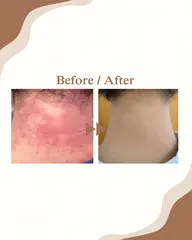 赤み&乾燥改善（90分）