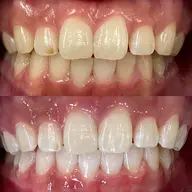 🦷minimo限定価格🦷12分×3照射 10000→3,500円❣️