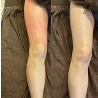 最強セル脂肪ケア♥️【大人気】スライドカッピング痩身 60分💥✨