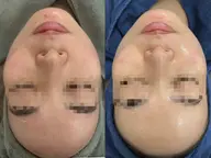 【韓国発🍊白玉水光肌🪄🫧】ララピール🧡