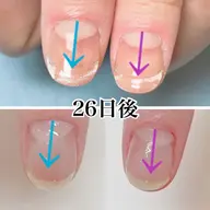 深爪矯正【3ヶ月】ケア商品付き