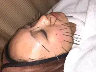 お得💖美容鍼90分✨ 顔に40本/超音波｡ラジオ波｡かっさ｡整顔😁ヒト幹細胞｡