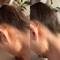 脱毛 Mパーツ【うなじ/両ひじ上/両ひじ下/腰】