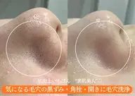 【 学生向け 】いちご鼻・毛穴つまりごっそり洗浄◎( 毛穴診断付き♪)