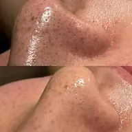 鼻の毛穴徹底大掃除🧹ハイドラAHAピーリング液塗布して角栓や毛穴詰まりをゆるゆるにしてから、さぁ！バキューム吸引✨水素