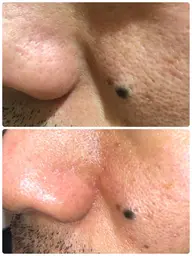 角栓クレンジングフェイシャル