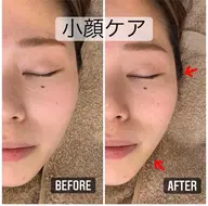 💟小顔水光肌コース💟SNSで話題のEMSでアゴ フェイシャルラインむくみ0💕小顔/むくみ/毛穴/美白/ツヤ/韓国/