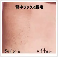 🟣WAX脱毛🟣ブライダルプラン【背中(上)+うなじ+腕(上)+デコルテ】3カ所選択☆1回でOK！挙式日5​〜​7日前迄！