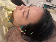 【美容鍼】