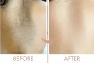 うなじ、背中脱毛