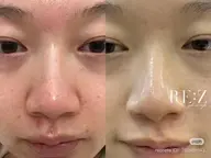 【30分で毛穴改善/促進🌿】小鼻ワックス＋韓国肌質改善＋プラセンタ美容液ケア💫