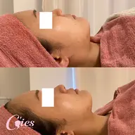 【新年度キャンペーン】　左右差改善、Vラインリフト、二重顎撃退、ほうれい線改善