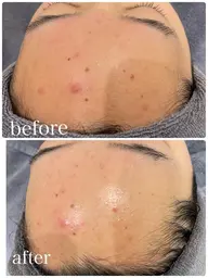 天然ミネラルベースのソフトピーリングで角質オフ！ニキビ、くすみ、ざらつき、毛穴の詰まりもスッキリお肌ツルツルに♪