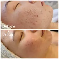 人気NO1 【肌質改善】ハーブピーリング┊︎繰り返すニキビ・ニキビ跡・毛穴・ごわつき・くすみ・色素沈着・シミ┊︎ツヤ肌