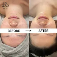 【ニキビ・ニキビ跡ケア】REVIハーブピーリング AI肌診断×陶肌パウダー+IPSP幹細胞セラム入り🎁