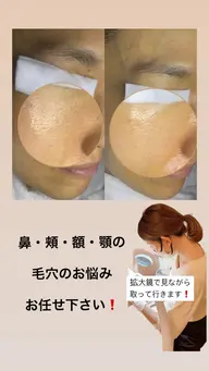 毛穴改善コース（毛穴の黒ずみ根こそぎお掃除）