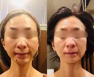 シンメトリー小顔矯正&ウルトラ筋膜リリースで、小顔と肩、首こりの解消も◎たるみやほうれい線、マリオネットラインにも◎