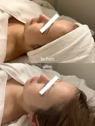 〈人気NO1✨〉 暖かい石膏パックで陶器肌へ🤍 毛穴引き締め・ハリ・ニキビ跡に｜肩首リンパ×小顔マッサージ 60分