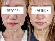 導入キャンペーン【小顔リフトアップ】美顔筋♪テラ鉱石パック&FGFセラム付 動画撮影OKでさらに500円引き!