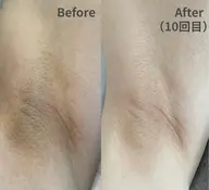 【夏の露出前に】効果重視！脇＋両腕つるすべ脱毛 ￥3,300