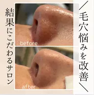 【小顔＆毛穴ひきしめフェイシャル】黒ずみ・角栓徹底除去➕毛穴ひきしめ保湿パック付き