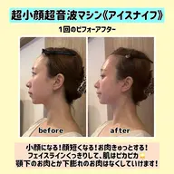 【写真モニター募集】超小顔超音波マシン《アイスナイフ》