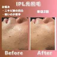 性別関係なく♡垢抜け全身脱毛♡（顔とVIO無し）初回限定❣️光の効果で♡ニキビ跡の凹凸、気になる黒ずみ、くすみさよなら