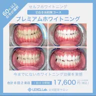 【初回限定・白さを極める】真っ白お約束・ プレミアムホワイトニング❣〈合計 70分照射 2 来店〉❣