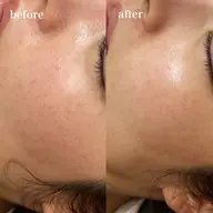 韓国美容✨【第四世代ピーリング🇰🇷全顔+首】