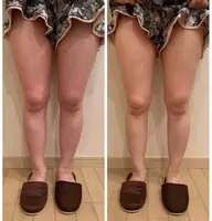 【キャビテーション】脚痩せコース🦵✨