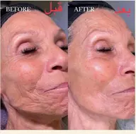 【シワ、たるみ、毛穴ケア】カーボキシー＋ゾンビマスク