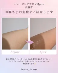 ミニモ＆夏限定メニュー☀️ 背中全体＋腕半分シェービング🪒