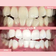 【医療提携ジェル】２回目以降のハイパワーホワイトニング60分で真っ白お約束［中島公園駅/札幌/ホワイトニング/すすきの］