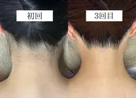 【成人式前撮り・イベント前に】うなじ＋お顔脱毛シェービング・高保湿パック付き🪒