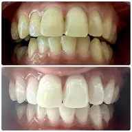 歯科提携ホワイトニング（過酸化水素9%使用）初回カウンセリング