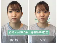 【3.40代必見!】法令線の深さ/骨格リフトアップ小顔矯正【50分17900→3900】