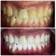 ✨一番人気✨【🔥圧倒的効果🔥】通常の倍照射！セルフホワイトニング8,800円🦷✨