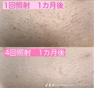 初回限定【VIO脱毛】カウンセリング込◎ニオイ、蒸れからの解放◎ストレスフリーな生活へ✨介護脱毛をお考えの方