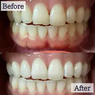 【継続ケアで白い歯へ】8分照射×4回セルフホワイトニング