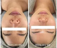 【毛穴のプツプツ詰まり・ベタつき改善】ハーブピーリング+生酵素 ¥15,400→¥9,900