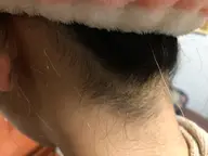 ハイブリッドえりあし脱毛