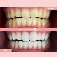 【医療提携ジェル付】５～６トーンUP◎ハイパワーホワイトニング 30分照射［中島公園駅/札幌/ホワイトニング/すすきの］