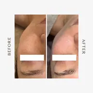 人気No.1✨機械2種使用＋デコルテマッサージ込み💆‍♀️▶ ハリ・シワ・美白を同時にスペシャルケア❗️