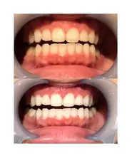 【✨ご新規様限定✨今月限定！口コミ書いてくださる方限定✨】〈歯科医師提携のホワイトニング剤使用〉セルフホワイトニング