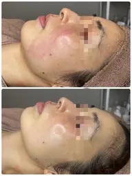 【ララピール+毛穴洗浄】半額以上◎韓国no.1肌管理で即艶水光肌◎+超音波毛穴洗浄で毛穴スッキリ