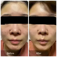 《男女OK》初回碧ハーブピーリングorマイクロニードルピーリング　¥6980