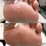 【トータル足裏ケア】足裏ゴワゴワ角質や痛〜い魚の目、かかとのガサガサをキレイに取り除きスベスベの足裏へ💁♀️